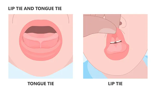 Infographic of tongue tie and lip tie: Collective Smiles San Diego